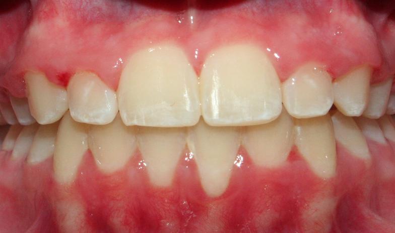 Braces After