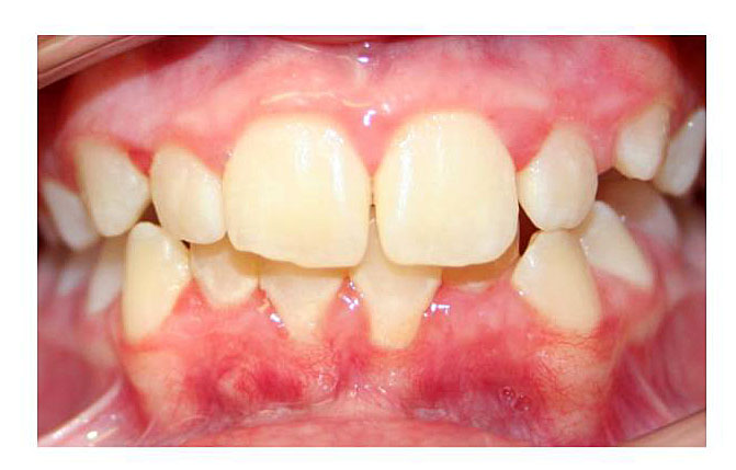 Braces Before