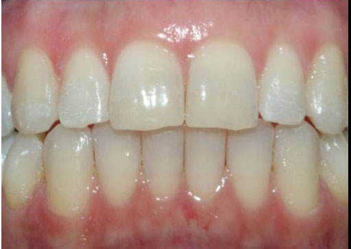 Invisalign After