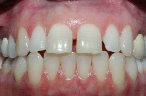 Invisalign Before