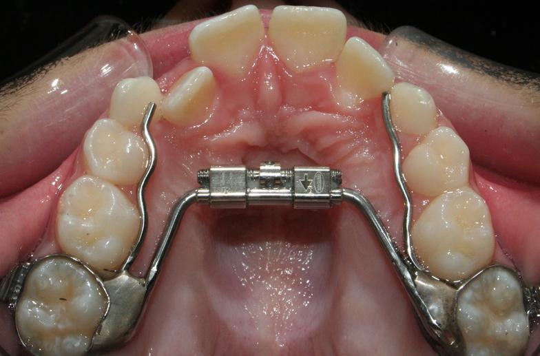 Palate expander