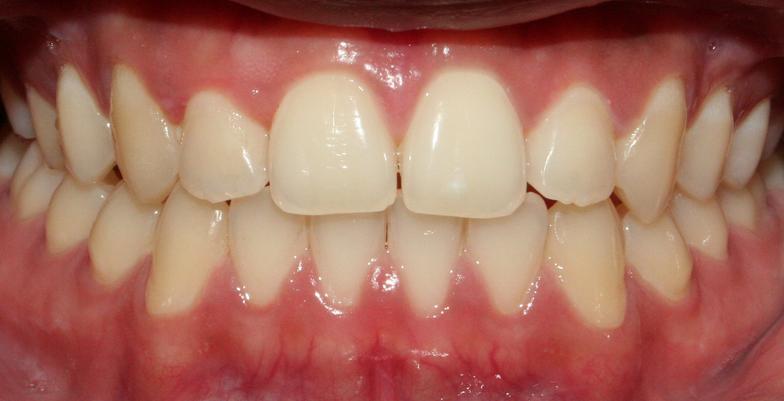 Underbite correction with Invisalign-After