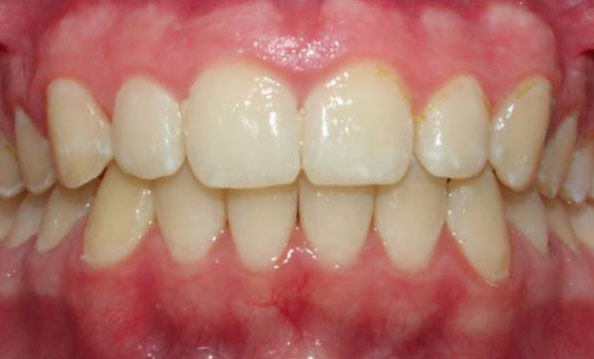 Deep overbite correction with Invisalign-After