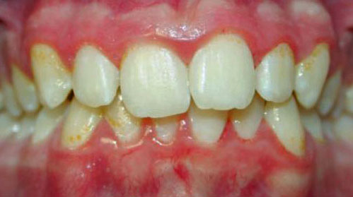 Deep overbite correction with Invisalign-Before