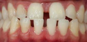 Underbite correction with Invisalign-Before