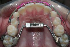 Palate expander