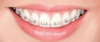 Clarity Advanced Ceramic Brackets