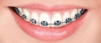 TP Orthodontics Nu-Edge